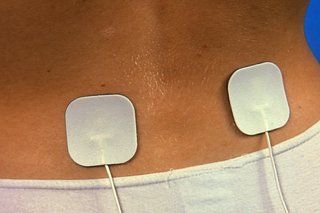 Picture of TENS machine electrodes on skin