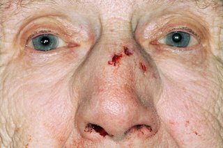 An elderly lady with a cut on her nose and a nosebleed
