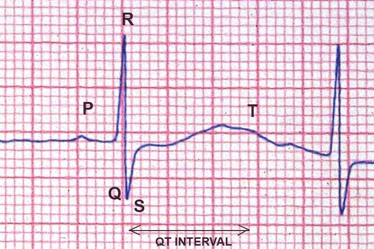 long-qt-syndrome-nhs