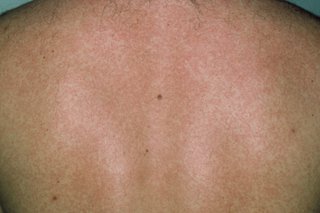 A spotty rash on the back of someone with dark skin