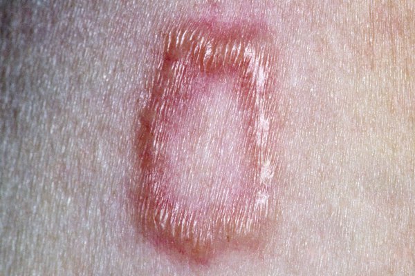 Picture of localised granuloma annulare