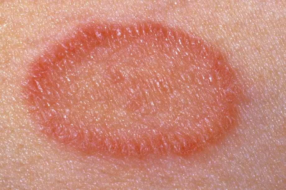 Pityriasis rosea - NHS.UK