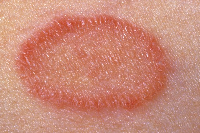 Pityriasis Rosea Nhs