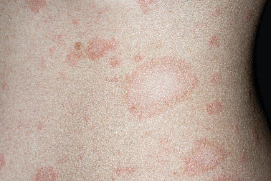 skin-rashes-in-children-nhs-uk