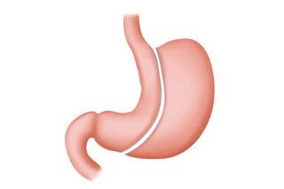 An illustration of a sleeve gastrectomy