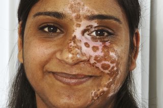 Gambar seorang wanita dengan vitiligo segmental yang mempengaruhi wajah
