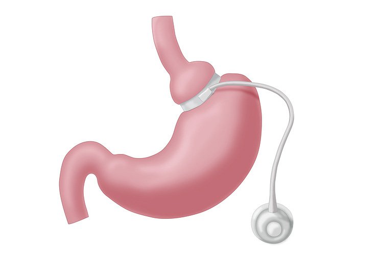 An illustration of a gastric band