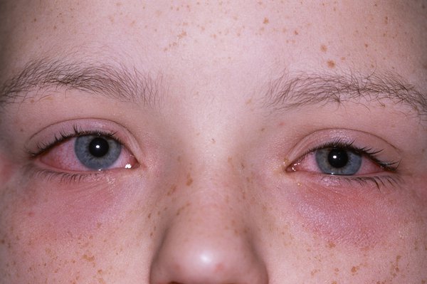 Itchy, red, watering eyes Image Credit: DR P. MARAZZI/SCIENCE PHOTO LIBRARY