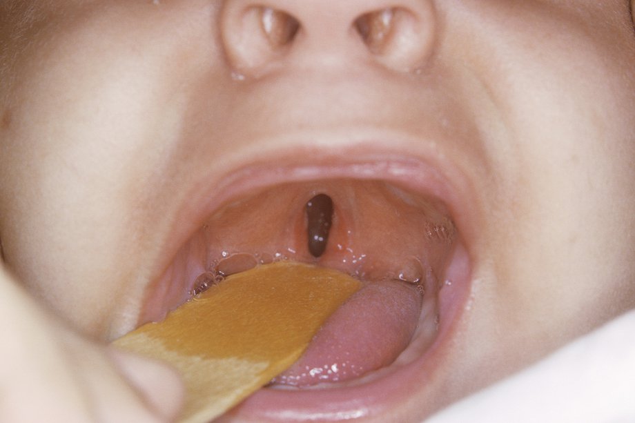 Picture of cleft palate