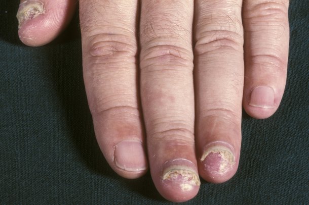 Nail Abnormalities - NHS.UK