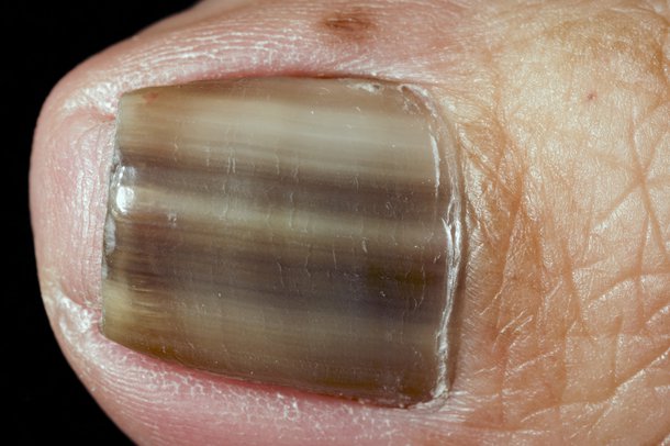 What Causes Black Nail Beds