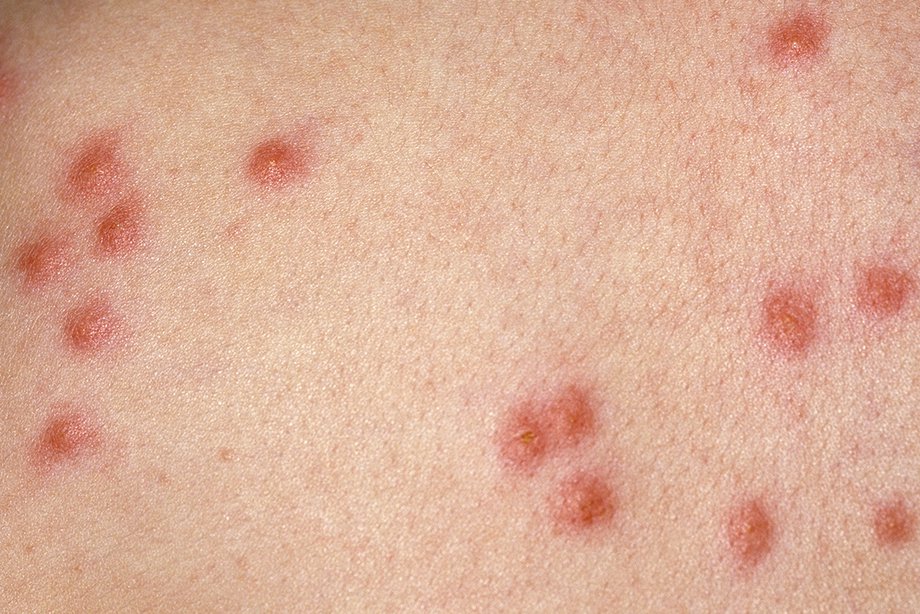 cluster of bug bites that itch