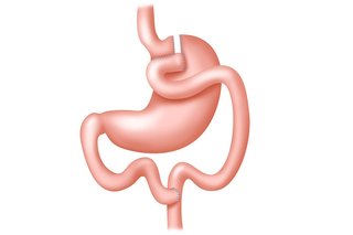 An illustration of a gastric bypass