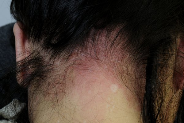 Red, irritated skin on the back of the neck and scalp from a reaction to hair dye
