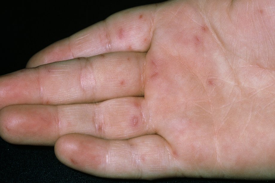 Skin rashes in children NHS.UK