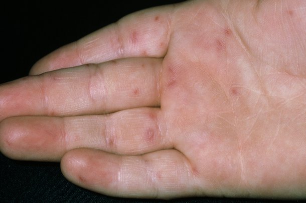 Hand Rashes In Adults 81