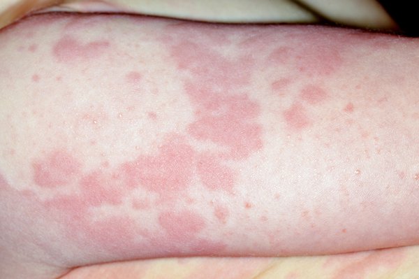 Raised, itchy, red rash (hives) Image Credit: DR P. MARAZZI/SCIENCE PHOTO LIBRARY