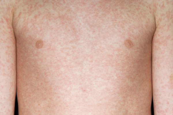 A measles rash appears around 2 to 4 days after initial symptoms Image Credit: DR P. MARAZZI/SCIENCE PHOTO LIBRARY