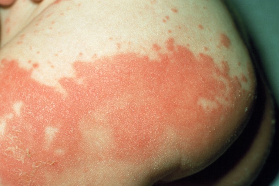 Skin rashes in babies - NHS