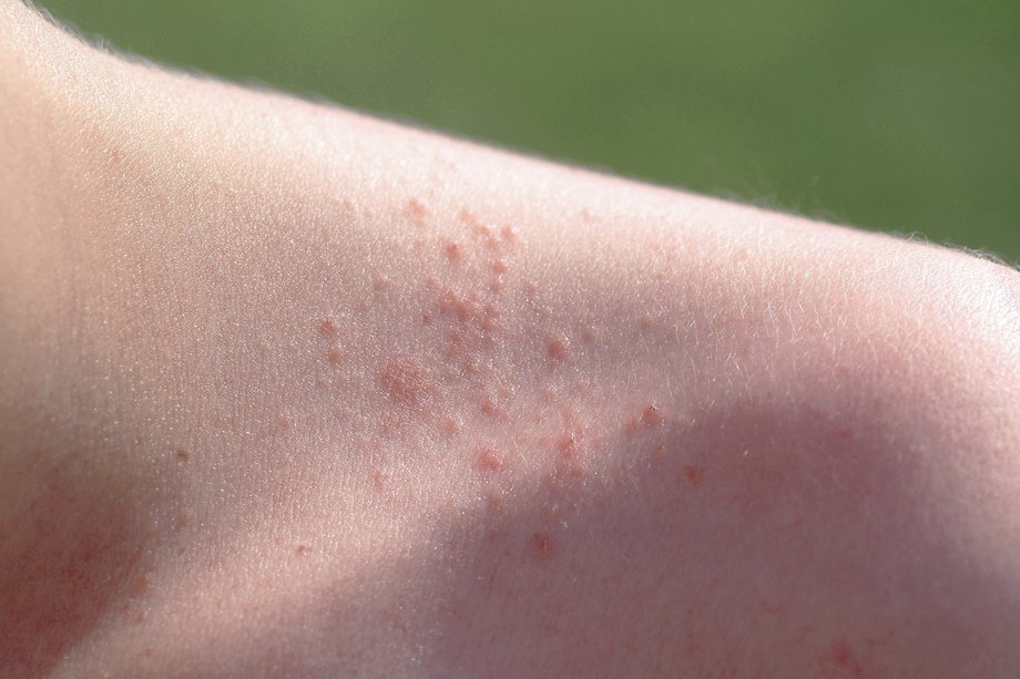 skin-rashes-in-children-nhs-uk