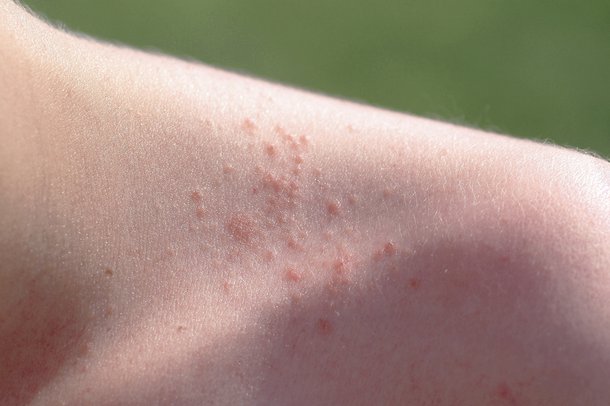 Picture of prickly heat rash