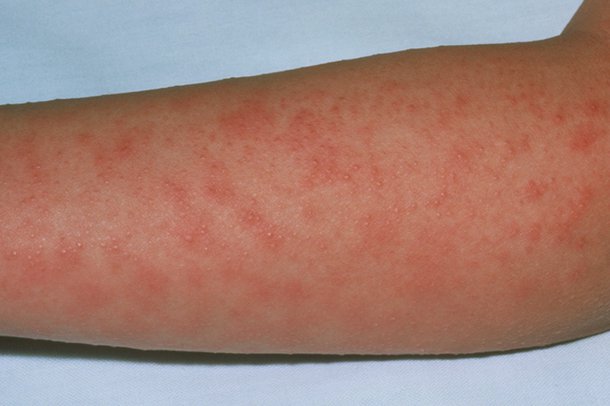 Picture of scarlet fever rash