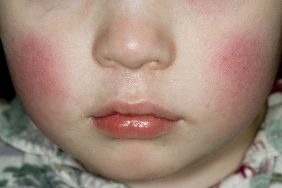 Skin rashes in babies NHS