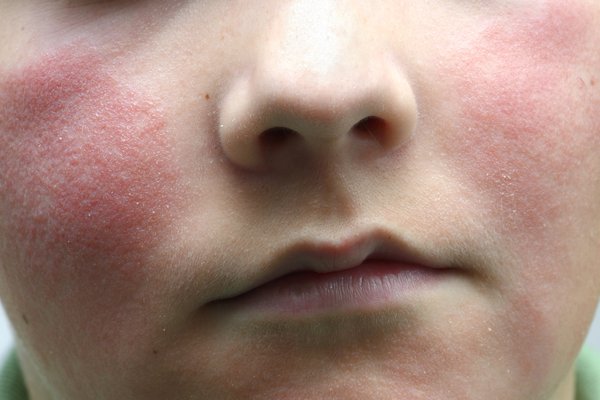 After 1 to 3 days, a bright red rash appears on both cheeks. Adults don't always get the rash