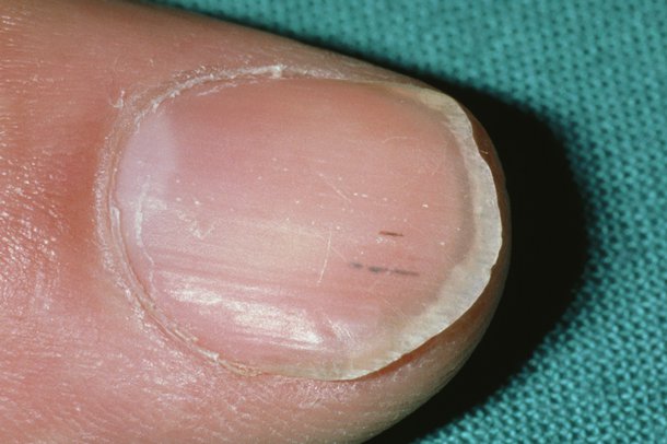 Red Spot Near Fingernail