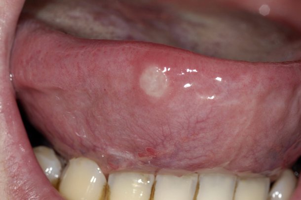 White Ulcer On Side Of Tongue