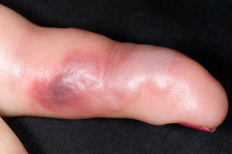 insect-bites-and-stings-symptoms-nhs