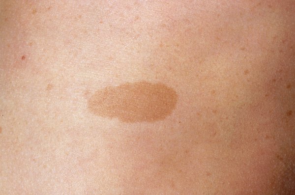 Close-up image of a flat, light brown patch on a person's skin. Image Credit: DR P. MARAZZI / SCIENCE PHOTO LIBRARY