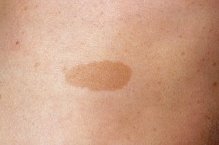 Close-up of a flat, light brown patch on a person's skin