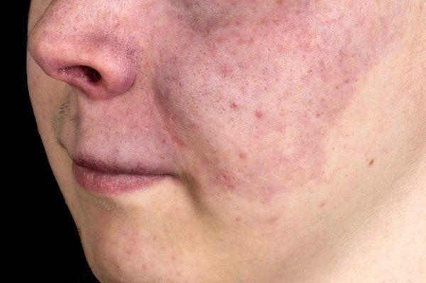 Image of a port wine birthmark on a person's cheek and nose. Image Credit: MID ESSEX HOSPITAL SERVICES NHS TRUST / SCIENCE PHOTO LIBRARY