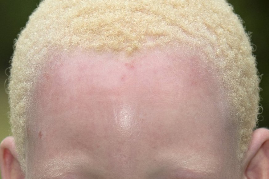 Picture of a young girl with albinism