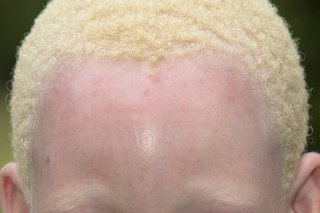 Albinism Nhs