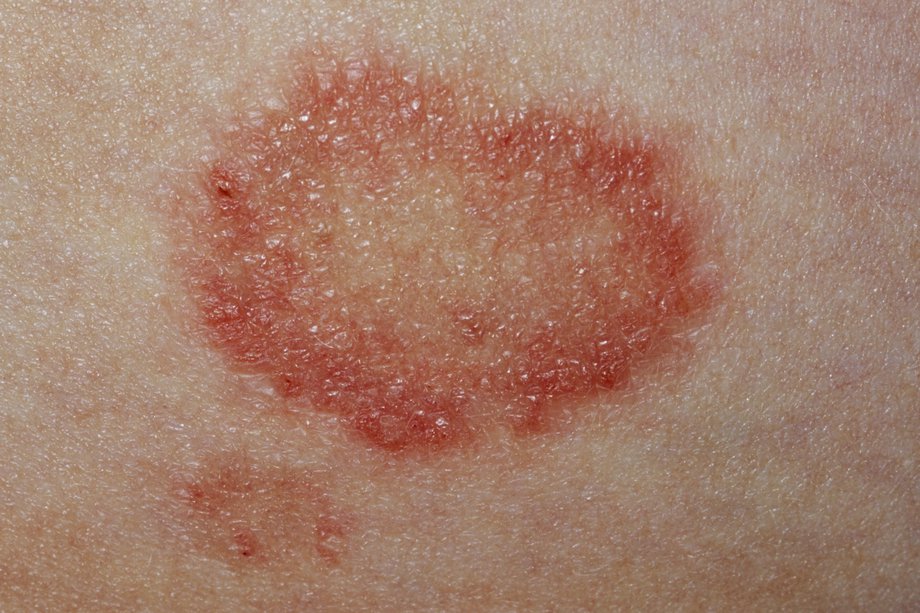 Common Skin Conditions Nhsuk