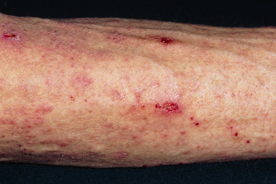 a small red rash on skin