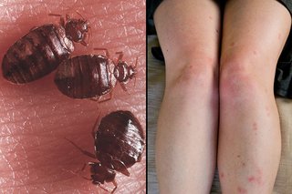 Bedbug bites