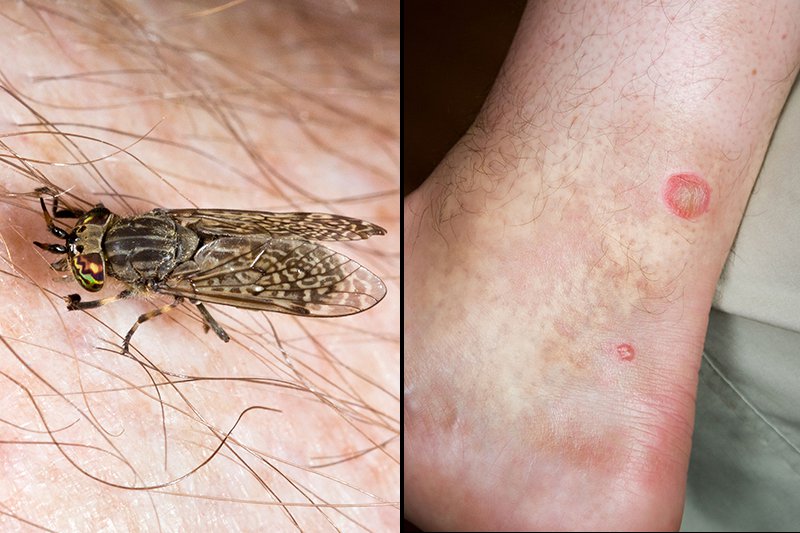 Insect bites and stings Symptoms NHS