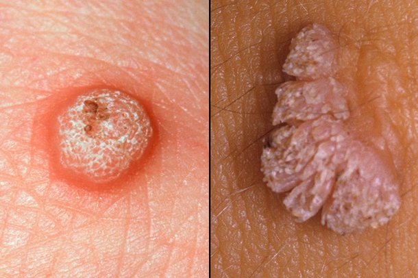 vaginal skin tags turned to genital warts