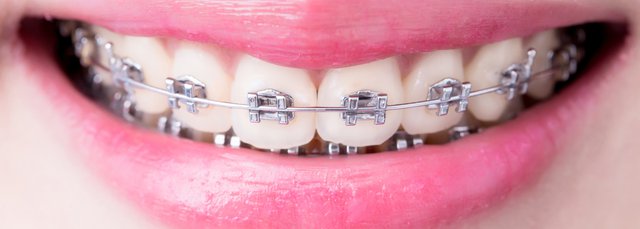 How To Whiten Teeth With Braces Home Remedies Teethwalls