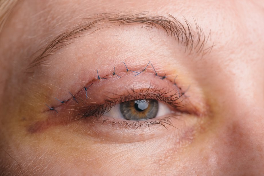 Eyelid surgery - NHS.UK