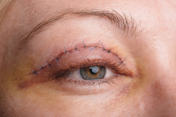 eyelid surgery nhs cosmetic thinkstock