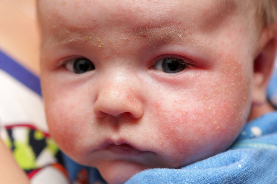 Allergic Reaction Heat Rash On Babys Scalp Identify Baby Eczema Images