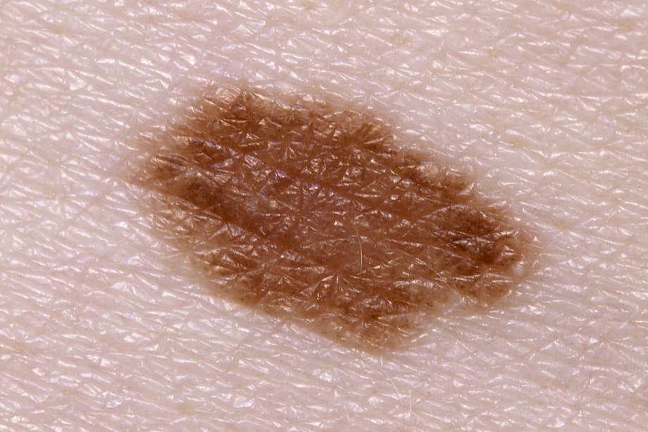 Picture of a normal mole