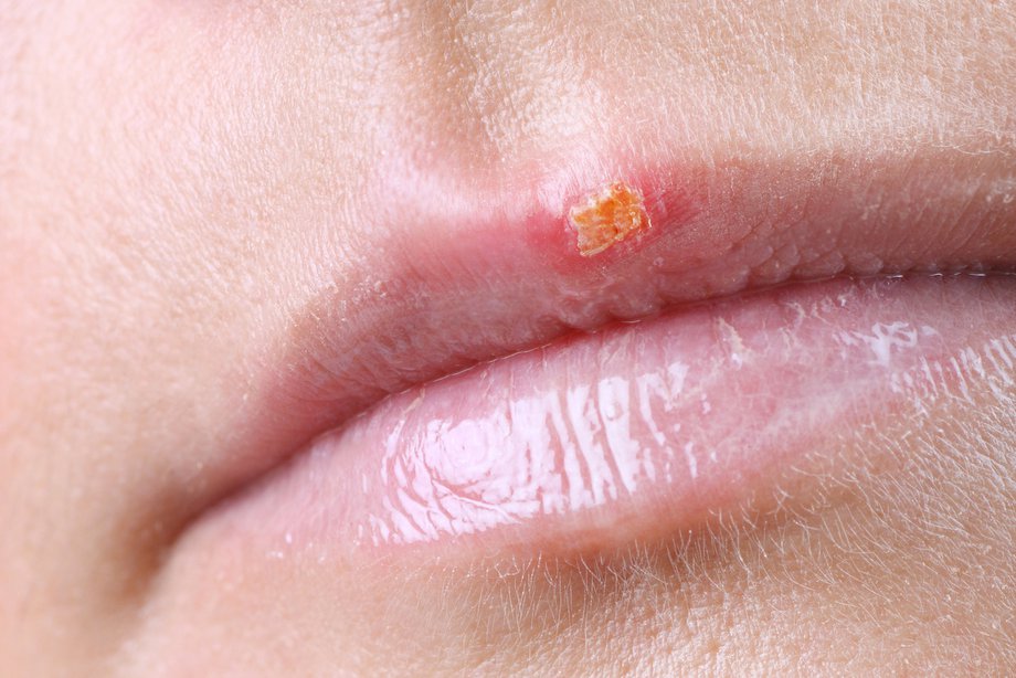 cold sore inside mouth