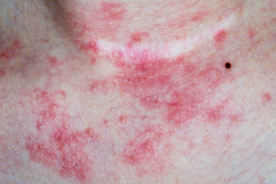 Rash On Chest Images Galleries With A Bite