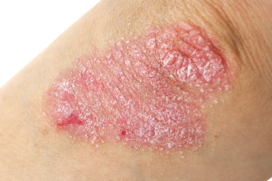 Common Skin Conditions Nhs