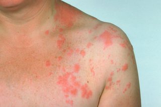 A red, blotchy rash on 1 side of the chest.